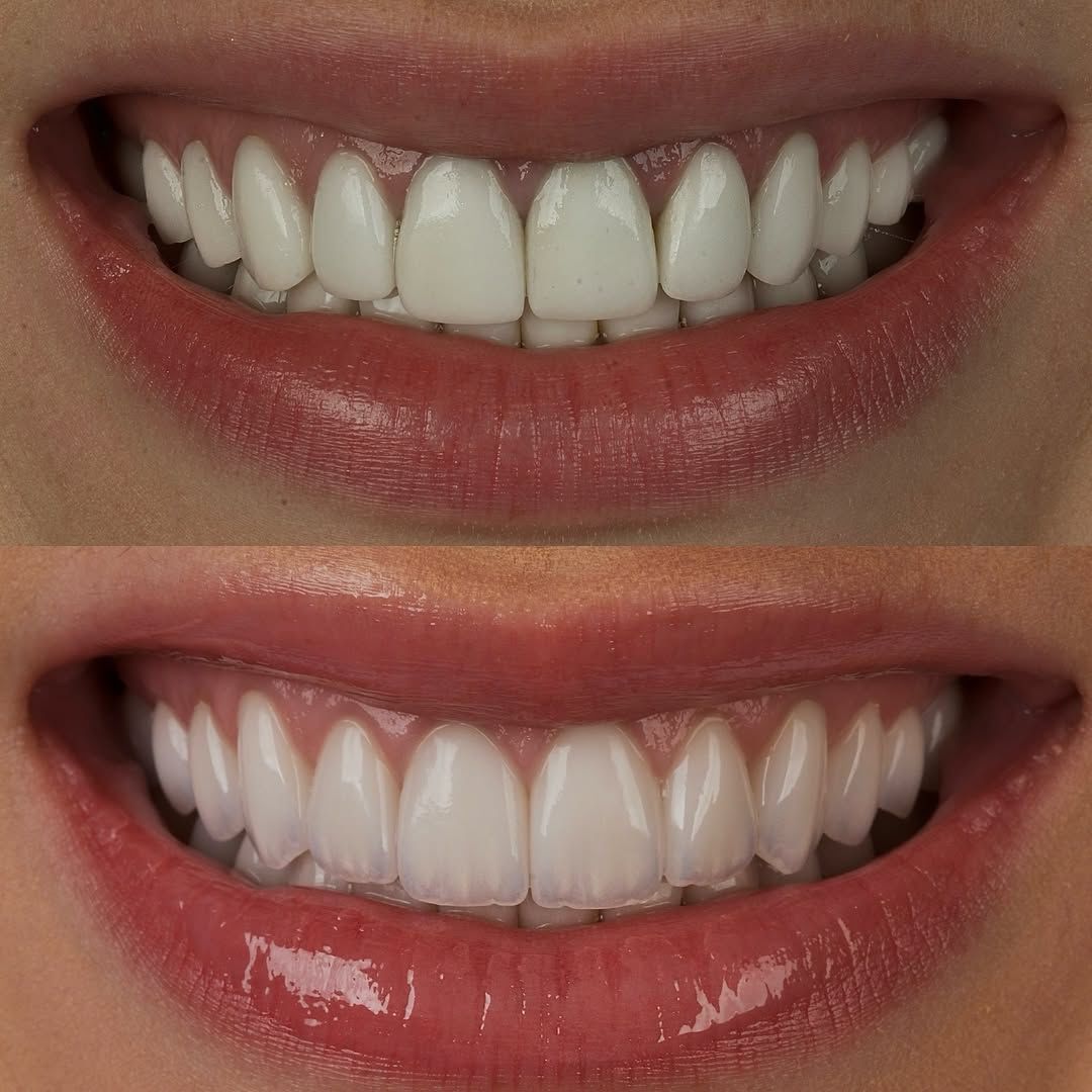 Patient F damaged teeth restoration